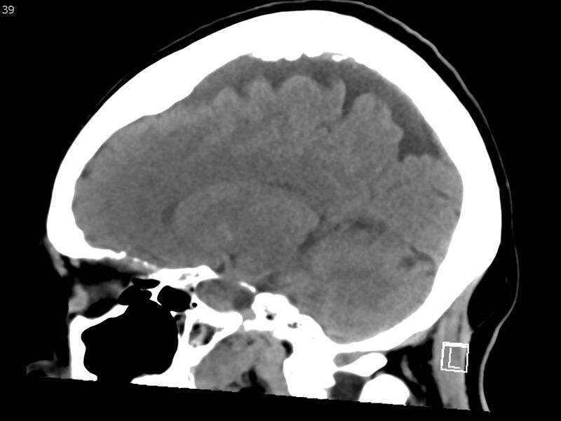 File:Atypical meningioma - intraosseous (Radiopaedia 64915-73867 C 37).jpg