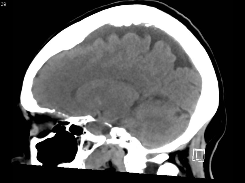 Atypical meningioma - intraosseous (Radiopaedia 64915-73867 C 37).jpg