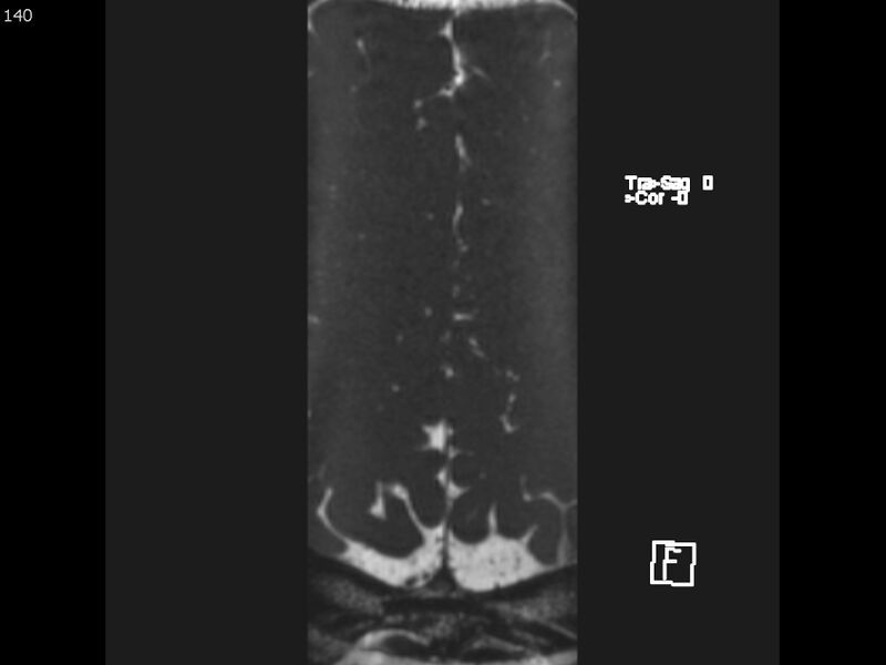 File:Atypical meningioma - intraosseous (Radiopaedia 64915-74572 Axial CISS 140).jpg