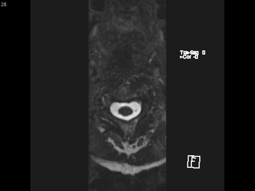 Atypical meningioma - intraosseous (Radiopaedia 64915-74572 Axial CISS 28).jpg