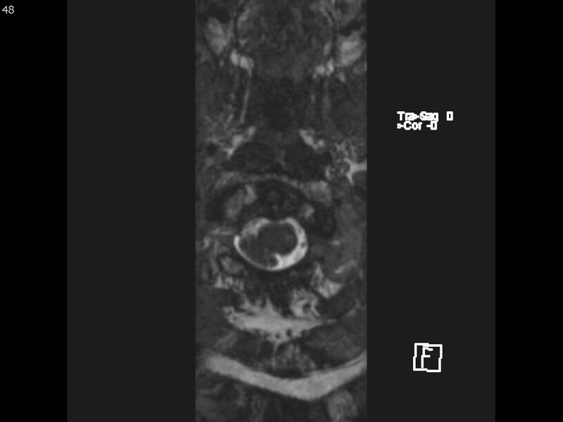 File:Atypical meningioma - intraosseous (Radiopaedia 64915-74572 Axial CISS 48).jpg