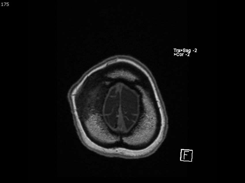 Atypical meningioma - intraosseous (Radiopaedia 64915-74572 Axial T1 175).jpg
