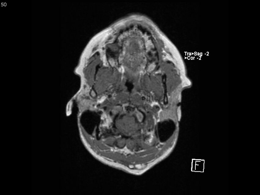 Atypical meningioma - intraosseous (Radiopaedia 64915-74572 Axial T1 50).jpg