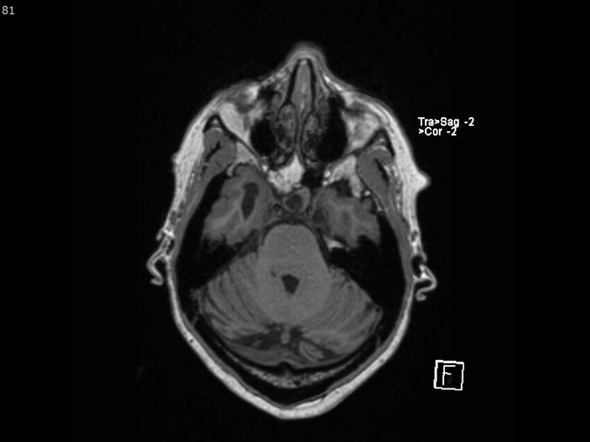 Atypical meningioma - intraosseous (Radiopaedia 64915-74572 Axial T1 81).jpg