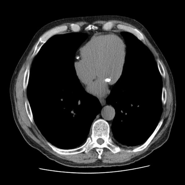File:Autosomal dominant polycystic kidney disease (Radiopaedia 27851-28094 Axial non-contrast 38).jpg