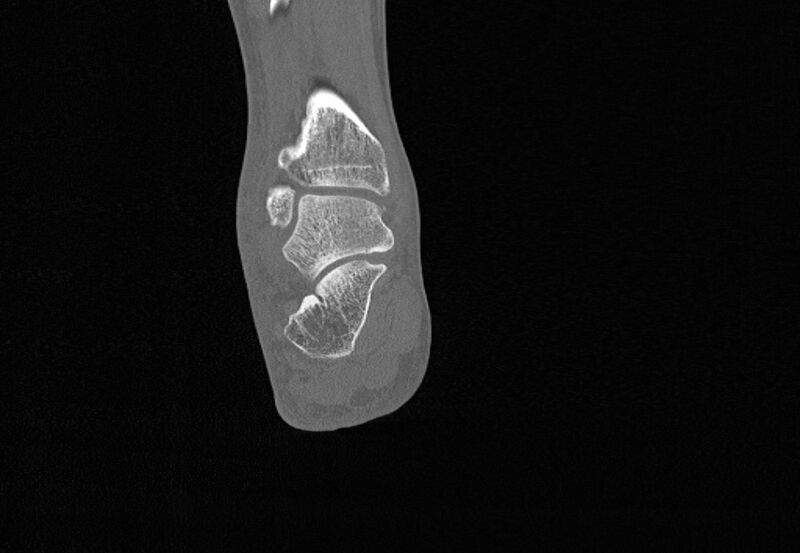 File:Avulsion fractures of talus and calcaneus (Radiopaedia 48277-53155 Coronal bone window 70).jpg