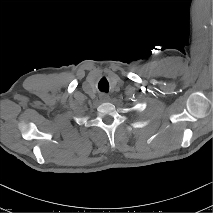 Azygos venous system anatomy (CT pulmonary angiography) (Radiopaedia 25928-26077 Axial C+ CTPA 3).jpg