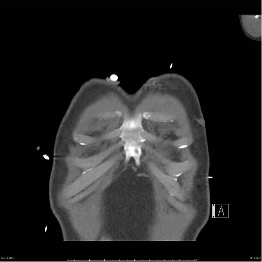 Azygos venous system anatomy (CT pulmonary angiography) (Radiopaedia 25928-26077 Coronal C+ CTPA 5).jpg