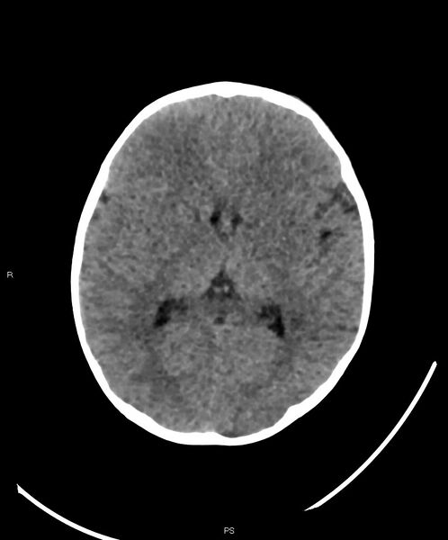 File:Basal ganglia and parenchymal ischemia (Radiopaedia 45818-50083 Axial non-contrast 22).jpg