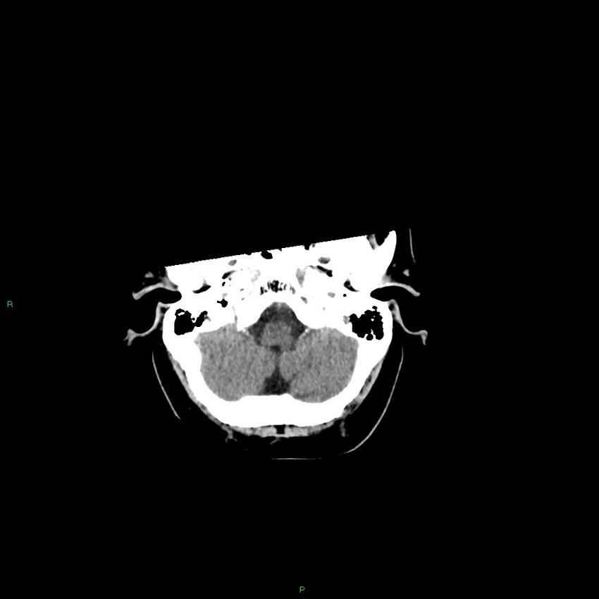 Basal ganglia hemorrhage (Radiopaedia 58346-65467 Axial non-contrast 48).jpg