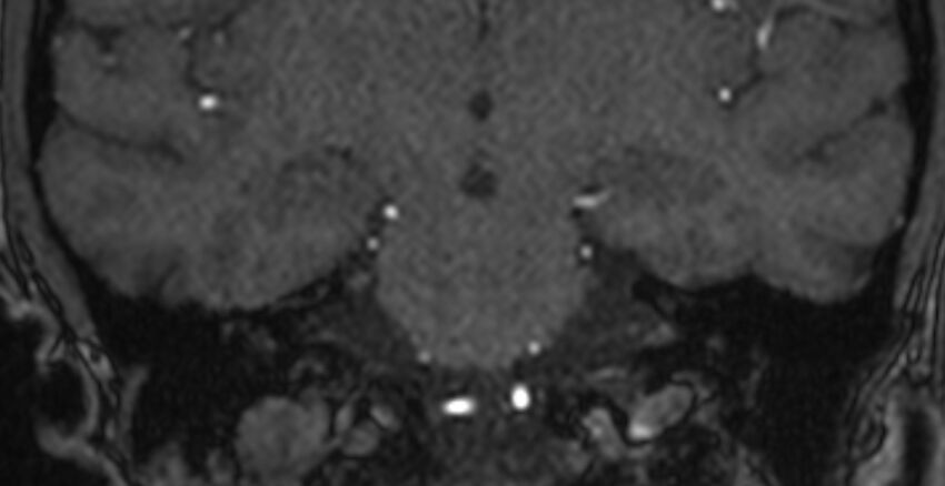 Basilar artery fenestration (Radiopaedia 74537-85455 Coronal MRA TOF 64).jpg