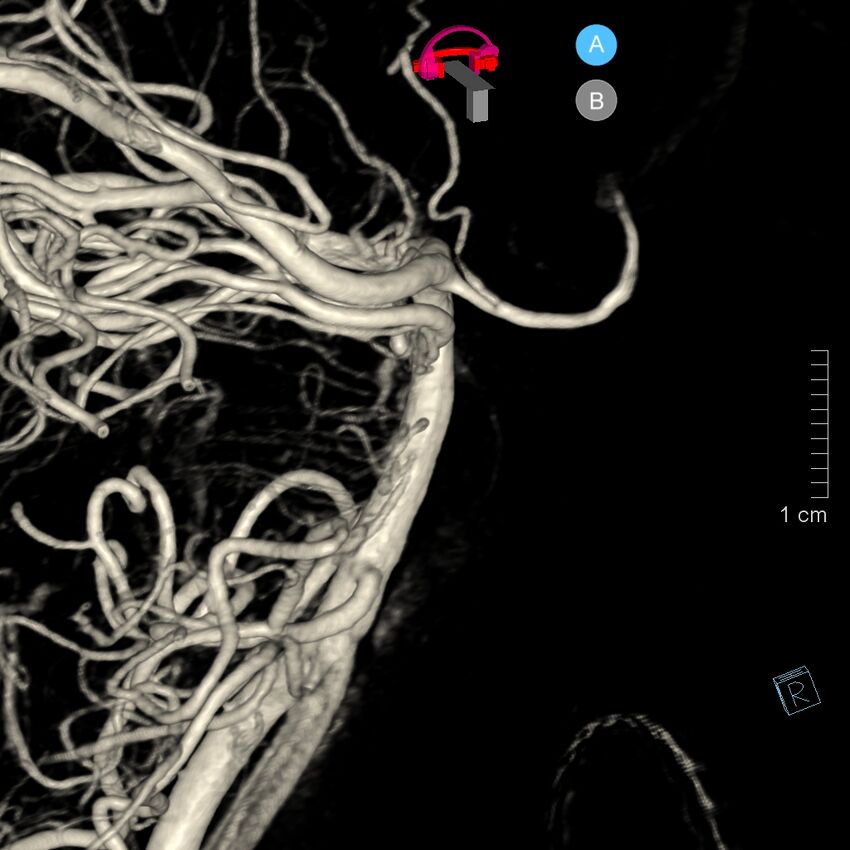 Basilar artery perforator aneurysm (Radiopaedia 82455-97734 3D view left VA 66).jpg