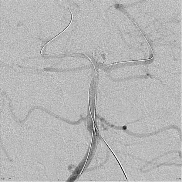 File:Basilar tip aneurysm double balloon remodeling (Radiopaedia 18100-17883 Right vertebral 1).jpg