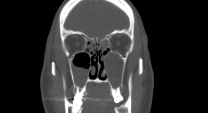 File:Benign mixed salivary tumor of the parotid gland (Radiopaedia 35261-36792 Coronal bone window 6).jpg