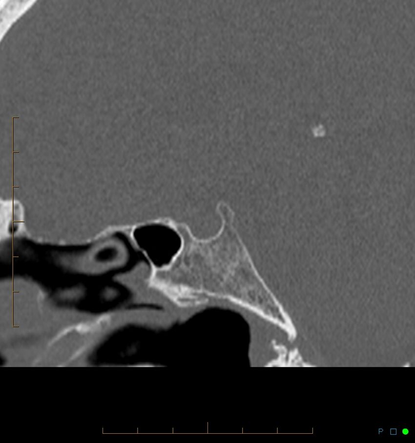 Benign notochordal cell tumor (probable) (Radiopaedia 65475-74546 Sagittal bone window 26).jpg