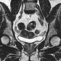 Bicornuate uterus (Radiopaedia 11104-11492 Coronal T2 11).jpg