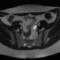 Bicornuate uterus (Radiopaedia 72135-82643 Axial T2 4).jpg