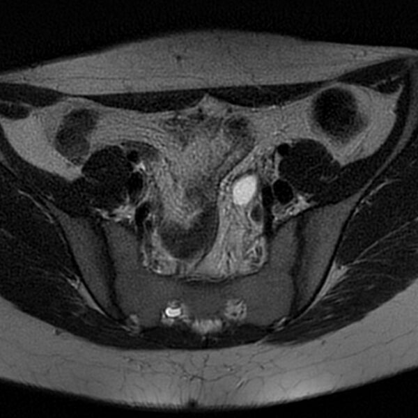 File:Bicornuate uterus (Radiopaedia 72135-82643 Axial T2 4).jpg