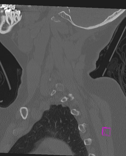 File:Bilateral atlanto-occipital assimilation (Radiopaedia 28350-28603 Sagittal bone window 19).jpg