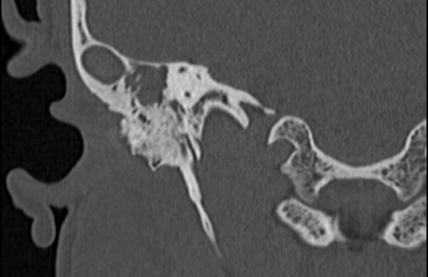 Bilateral cholesteatoma (Radiopaedia 54898-61172 Coronal bone window 54).jpg