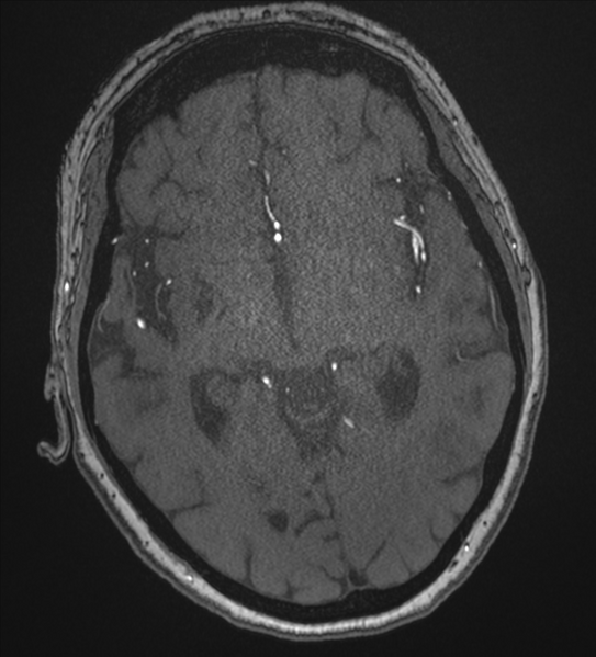 File:Bilateral fetal posterior communicating arteries (Radiopaedia 41286-44102 Axial MRA 100).png