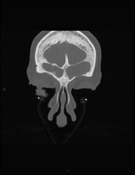 File:Bilateral frontal mucoceles (Radiopaedia 82352-96454 Coronal 56).jpg