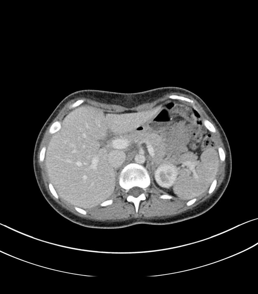Bilateral kidney malrotation (Radiopaedia 72227-82749 A 4).jpg
