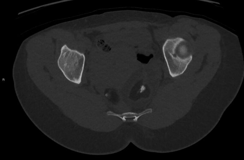 File:Bilateral mature cystic ovarian teratoma (Radiopaedia 88821-105592 Axial bone window 30).jpg