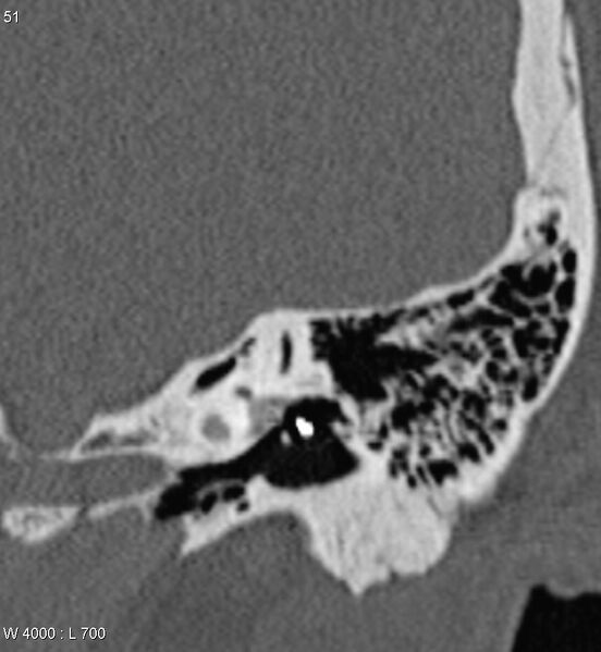 File:Bilateral otosclerosis with left stapes prosthesis (Radiopaedia 5567-7302 D 3).jpg