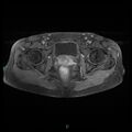 Bilateral ovarian fibroma (Radiopaedia 44568-48293 Axial T1 C+ fat sat 22).jpg