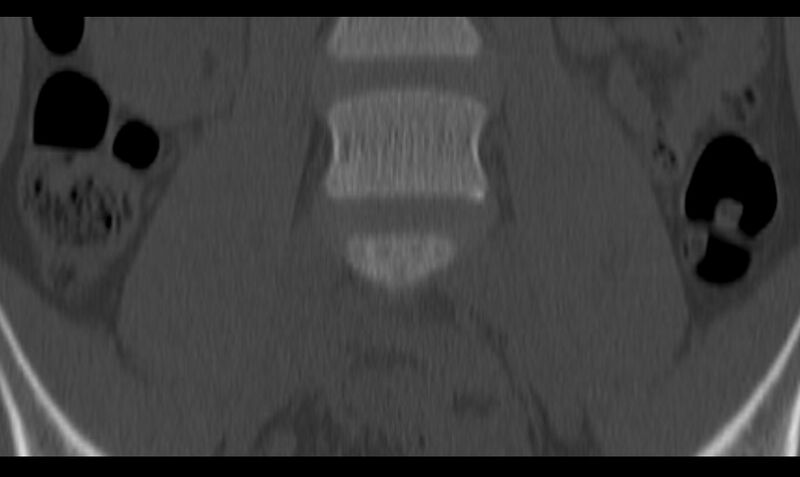 File:Bilateral pars defect (Radiopaedia 26691-26846 Coronal bone window 9).jpg