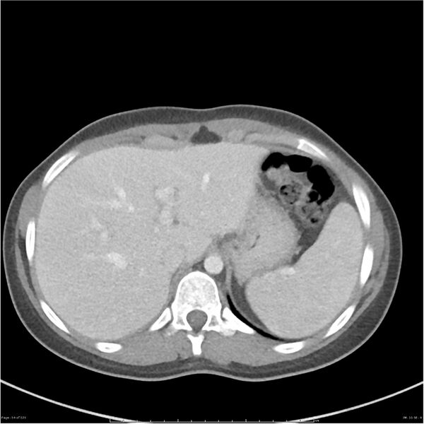 File:Bilateral ureteritis and cystitis (Radiopaedia 25340-25594 A 11).jpg