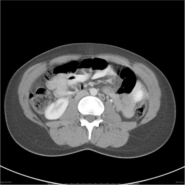 File:Bilateral ureteritis and cystitis (Radiopaedia 25340-25594 A 37).jpg