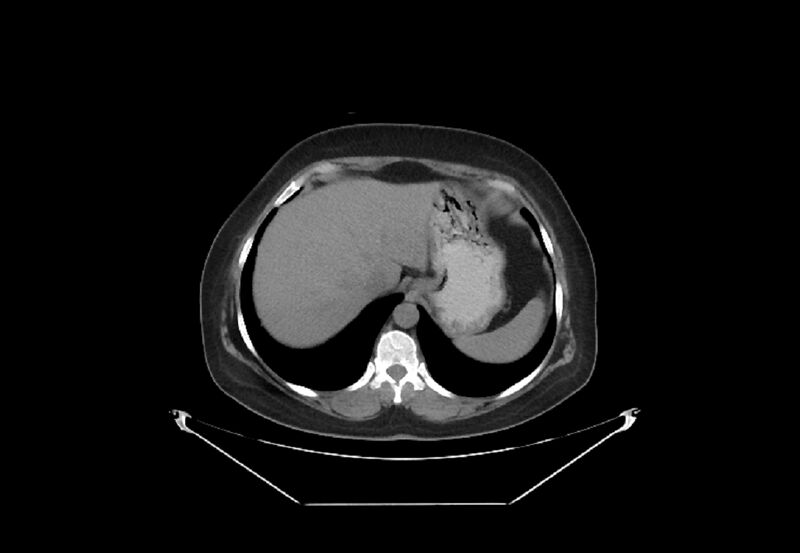 File:Bilateral urolithiasis with incidentally detected splenic artery aneurysm and left inferior vena cava (Radiopaedia 44467-48123 Axial non-contrast 3).jpg