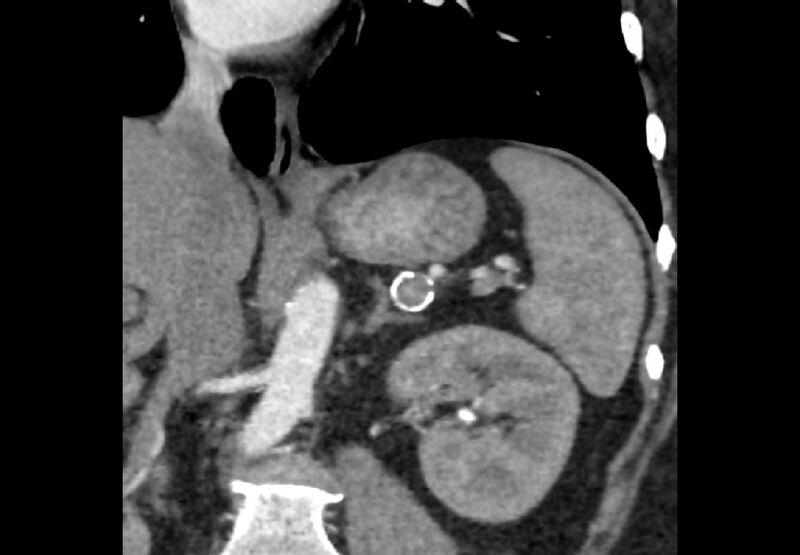 File:Bilateral urolithiasis with incidentally detected splenic artery aneurysm and left inferior vena cava (Radiopaedia 44467-48127 Ob. Cor. C+ Art. 8).jpg