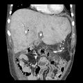 Biliary necrosis - liver transplant (Radiopaedia 21876-21846 C 12).jpg