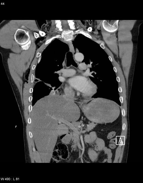 File:Boerhaave syndrome with tension pneumothorax (Radiopaedia 56794-63605 B 17).jpg