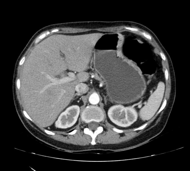 File:Bosniak renal cyst - type IV (Radiopaedia 22929-22953 B 24).jpg
