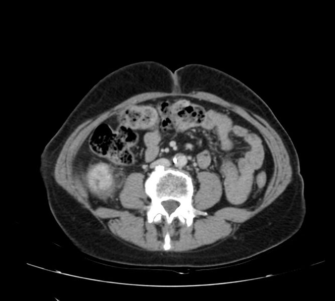 File:Bosniak renal cyst - type IV (Radiopaedia 22929-22953 C 35).jpg