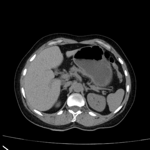 File:Bosniak renal cyst - type I (Radiopaedia 27479-27675 Axial non-contrast 23).jpg
