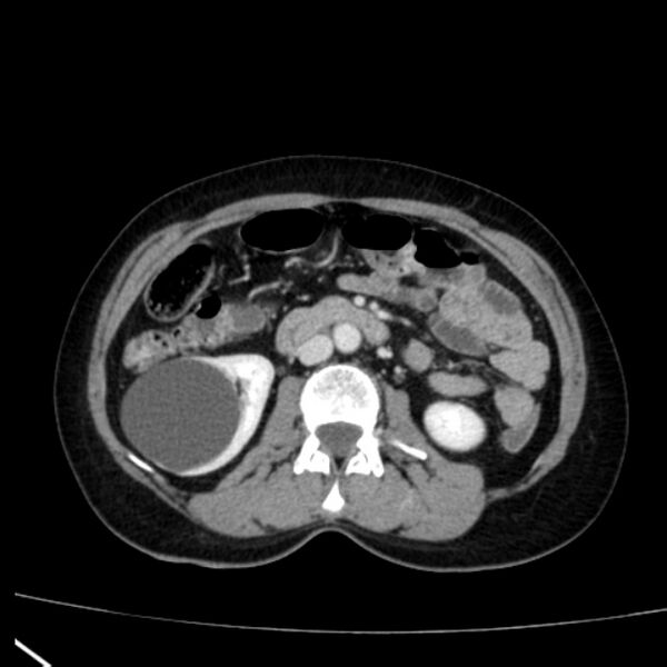 File:Bosniak renal cyst - type I (Radiopaedia 27479-27675 C 41).jpg