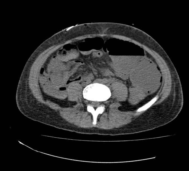 File:Bowel lymphoma complicated by bleeding after therapy (Radiopaedia 55601-62110 Axial non-contrast 52).jpg