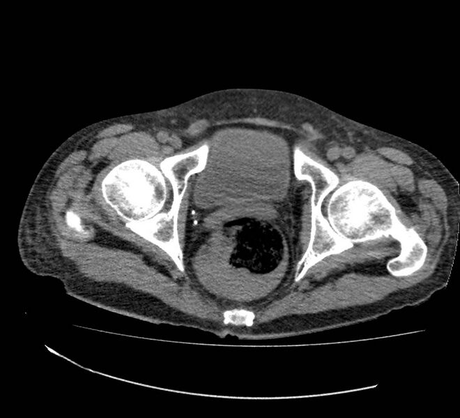 File:Bowel lymphoma complicated by bleeding after therapy (Radiopaedia 55601-62110 Axial non-contrast 78).jpg