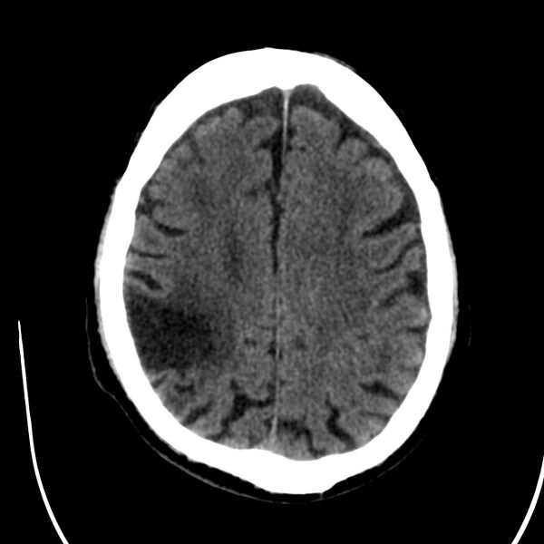 File:Brain Pantopaque remnants (Radiopaedia 78403-91048 Axial non-contrast 64).jpg