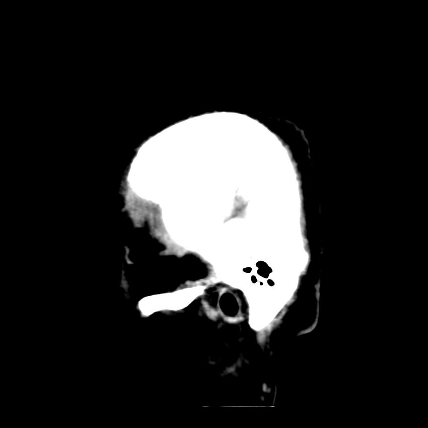 Brain Pantopaque remnants (Radiopaedia 78403-91048 C 4).jpg