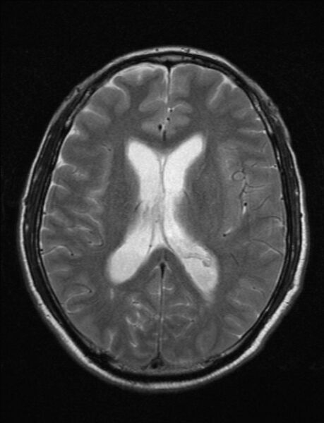 File:Brain abscess with ventriculitis (Radiopaedia 85703-101495 Axial T2 16).jpg
