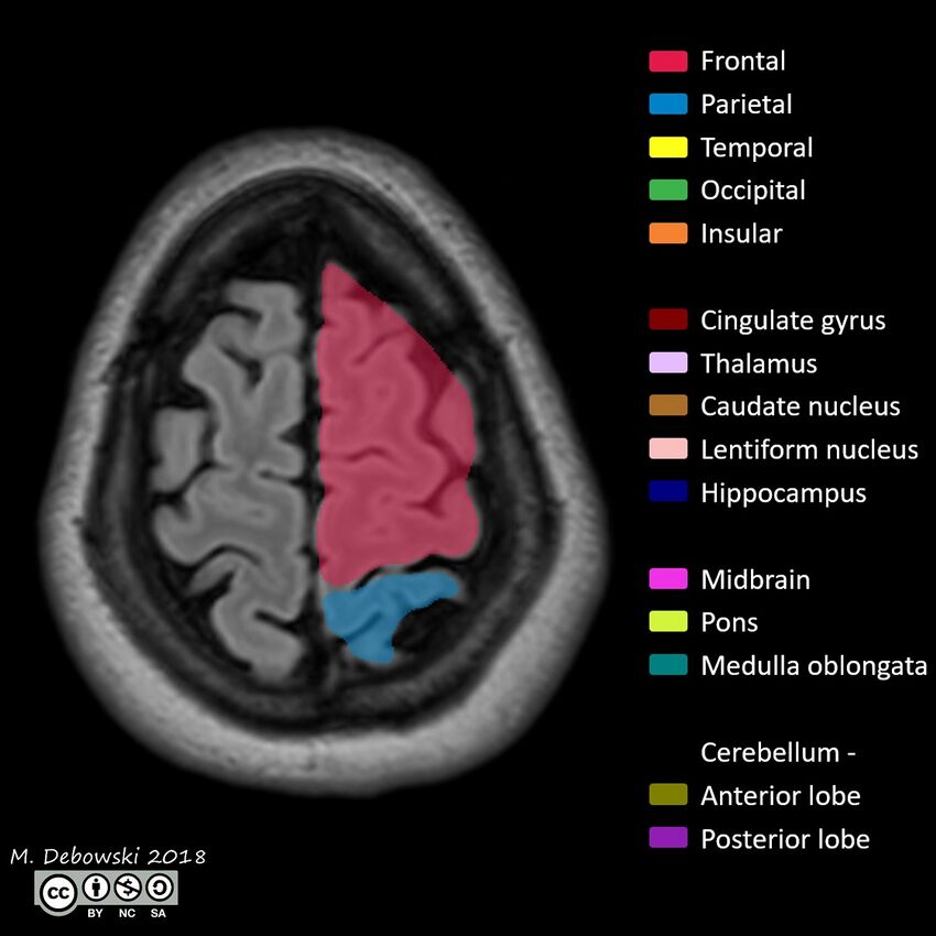 Brain lobes - annotated MRI (Radiopaedia 61691-69700 Axial 6).JPG