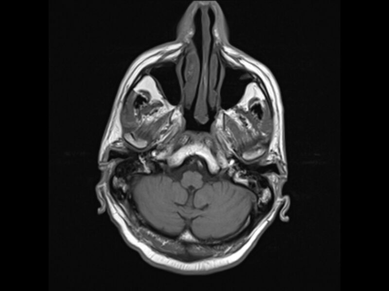 File:Brain metastases from renal cell carcinoma (Radiopaedia 42222-45297 Axial T1 5).jpg