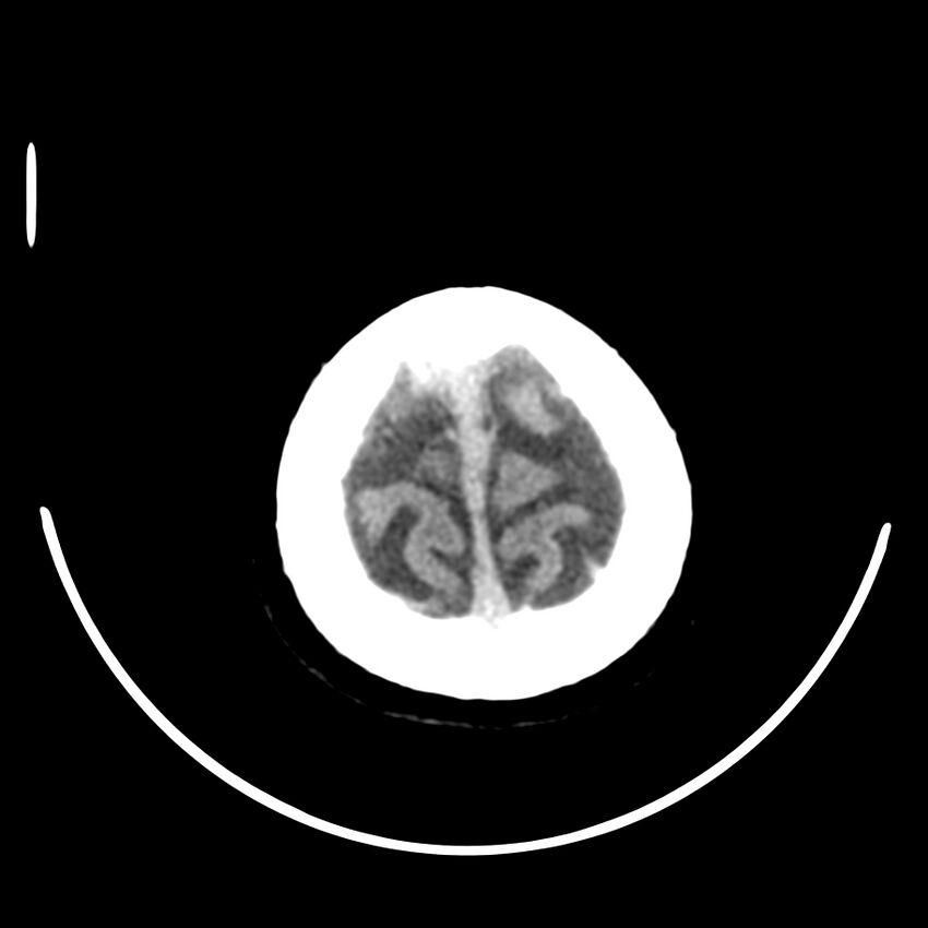 Brain metastasis (Radiopaedia 42617-45760 Axial non-contrast 49).jpg