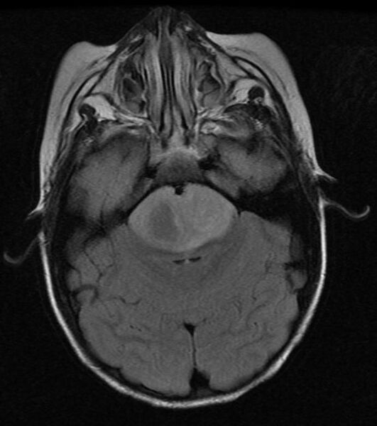 File:Brainstem glioma (Radiopaedia 11250-11614 A 1).jpg